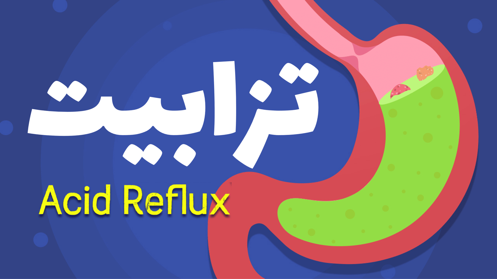 Acid Reflux (GERD)